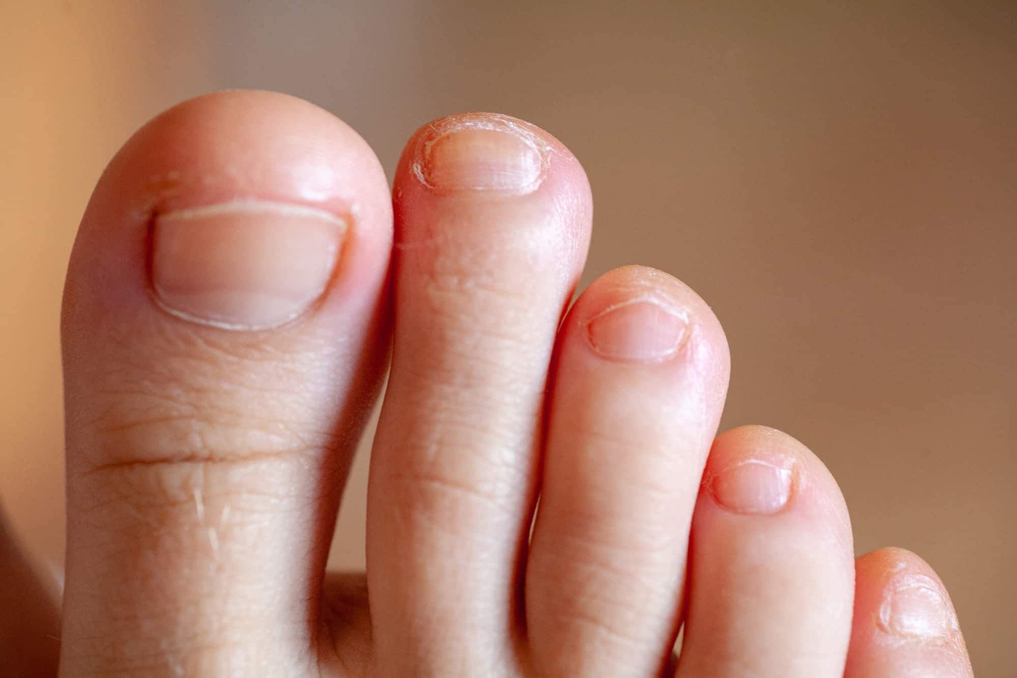 Почему Краснеют Ногти Пальцев На Ногах Фото