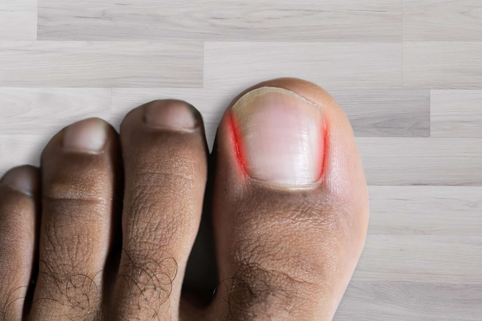 Toe Infection Warning Signs Causes And Treatments Digital Health Buzz