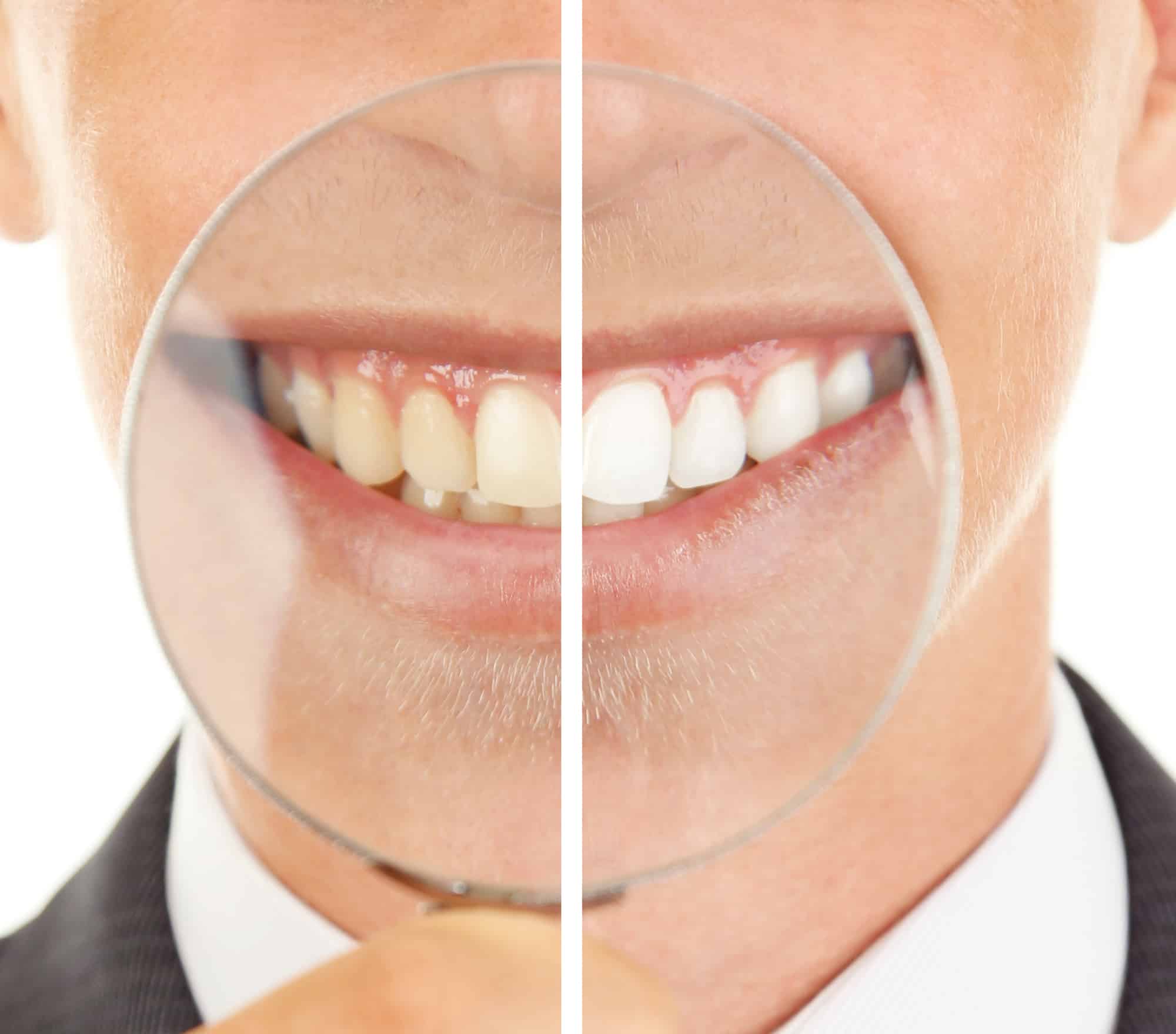 Does Zoom Teeth Whitening Work? Digital Health Buzz!