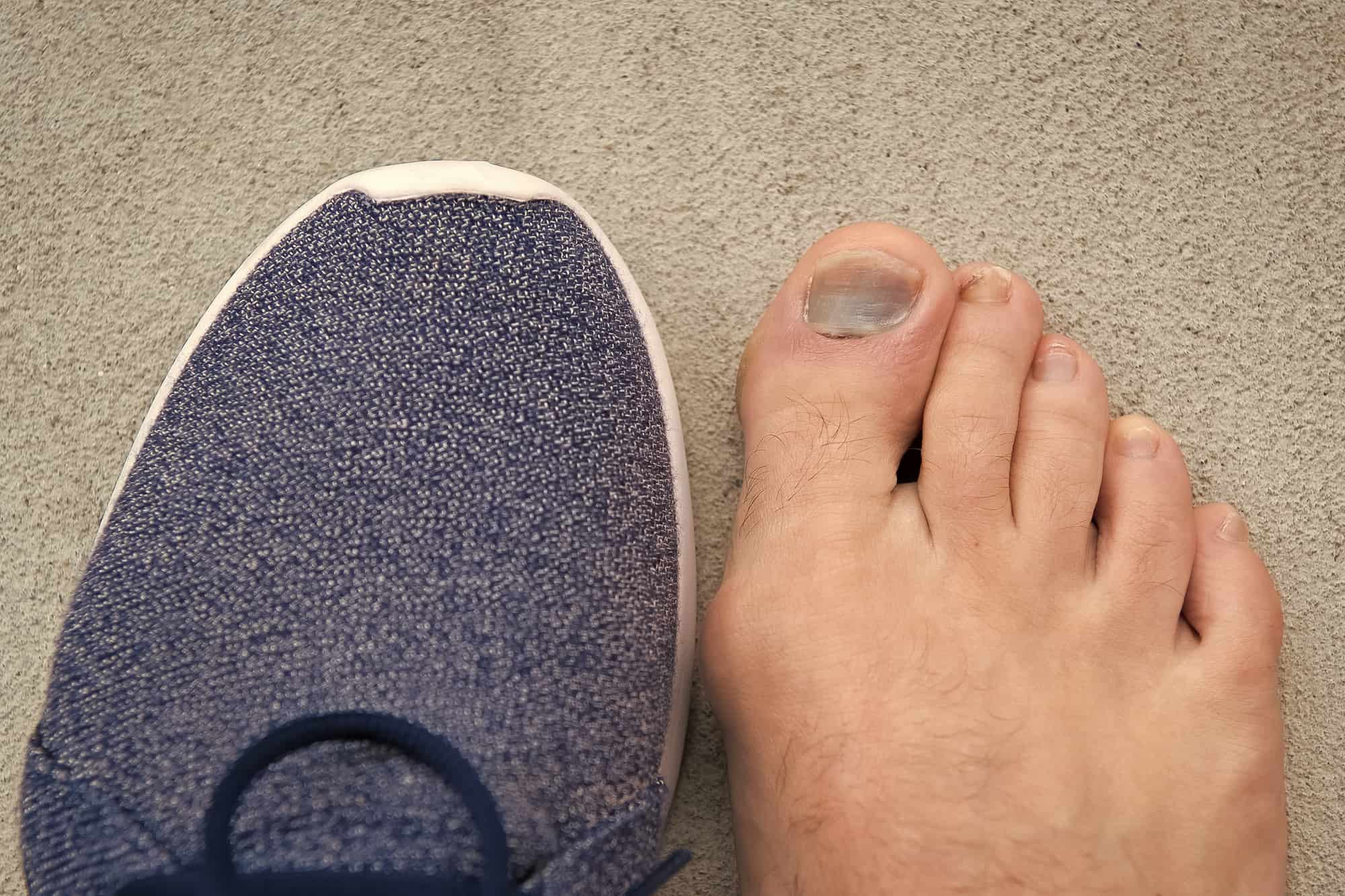 Синие ногти на ногах от обуви