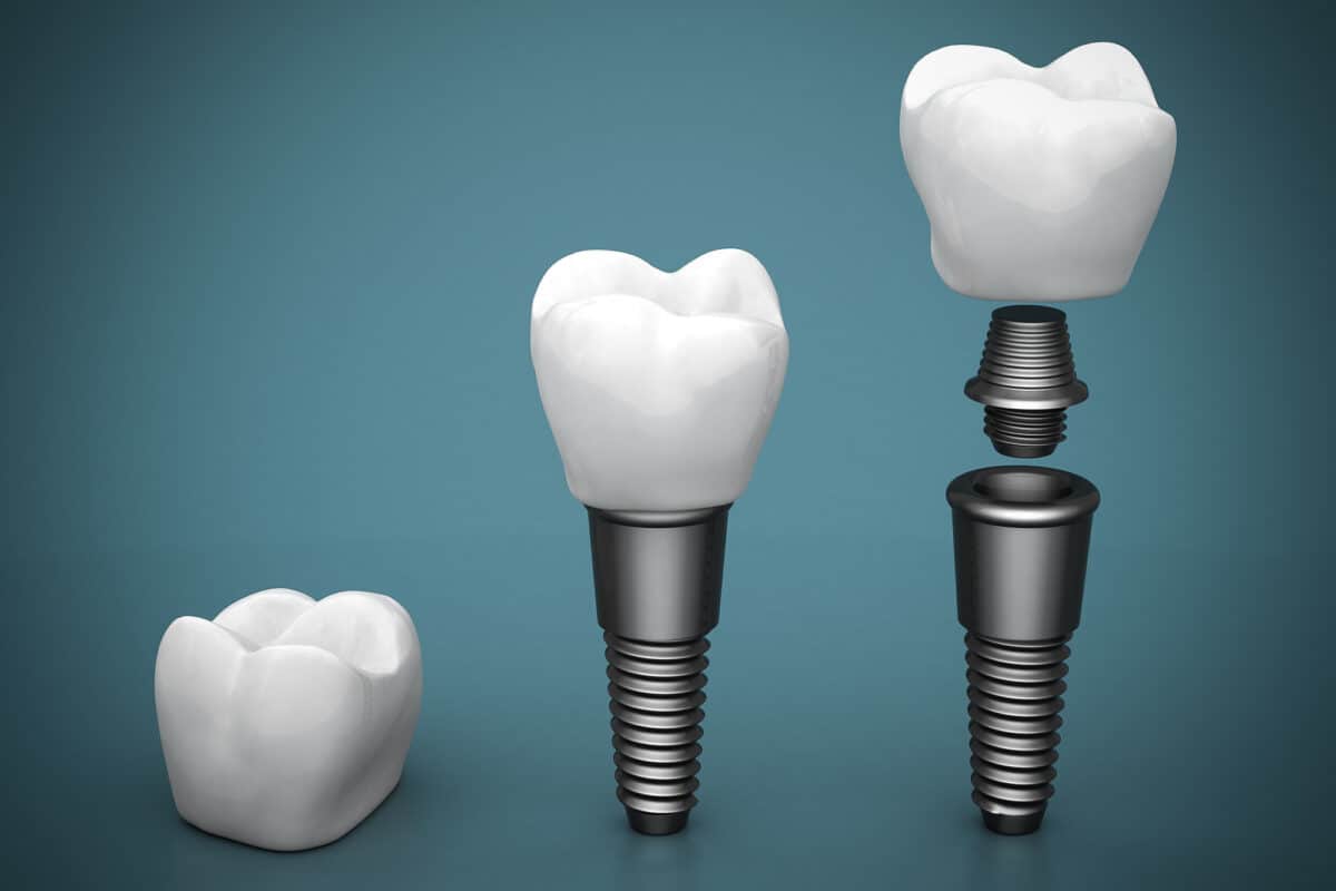 The Benefits of Dental Implants for Pensioners